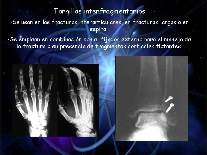 Tornillos interfragmentarios • Se usan en las fracturas interarticulares, en fracturas largas o en Tornillos interfragmentarios • Se usan en las fracturas interarticulares, en fracturas largas o en