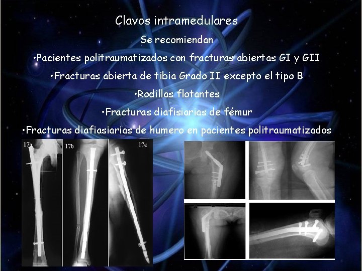 Clavos intramedulares Se recomiendan • Pacientes politraumatizados con fracturas abiertas GI y GII • Clavos intramedulares Se recomiendan • Pacientes politraumatizados con fracturas abiertas GI y GII •