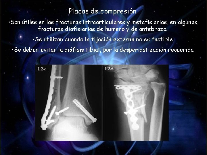 Placas de compresión • Son útiles en las fracturas intraarticulares y metafisiarias, en algunas Placas de compresión • Son útiles en las fracturas intraarticulares y metafisiarias, en algunas