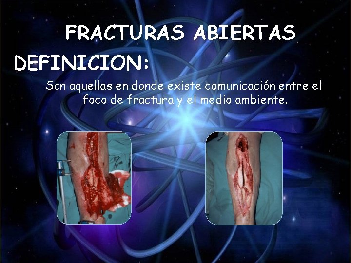 FRACTURAS ABIERTAS DEFINICION: Son aquellas en donde existe comunicación entre el foco de fractura FRACTURAS ABIERTAS DEFINICION: Son aquellas en donde existe comunicación entre el foco de fractura