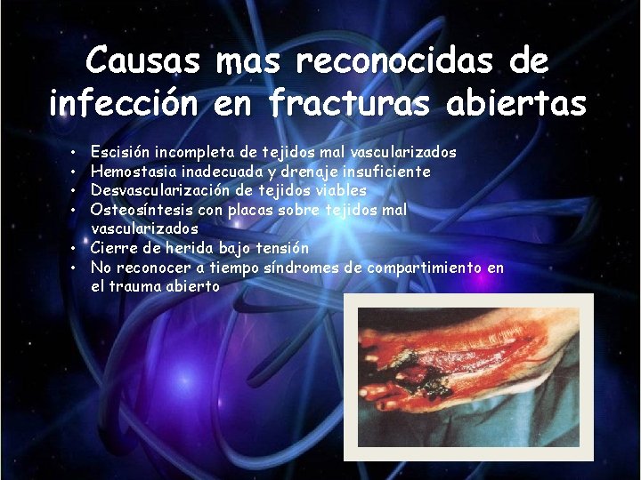 Causas mas reconocidas de infección en fracturas abiertas Escisión incompleta de tejidos mal vascularizados Causas mas reconocidas de infección en fracturas abiertas Escisión incompleta de tejidos mal vascularizados