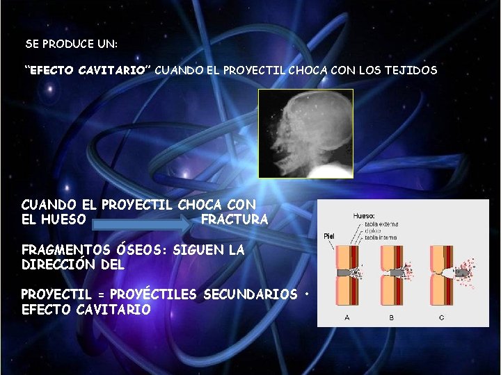 SE PRODUCE UN: “EFECTO CAVITARIO” CUANDO EL PROYECTIL CHOCA CON LOS TEJIDOS CUANDO EL SE PRODUCE UN: “EFECTO CAVITARIO” CUANDO EL PROYECTIL CHOCA CON LOS TEJIDOS CUANDO EL