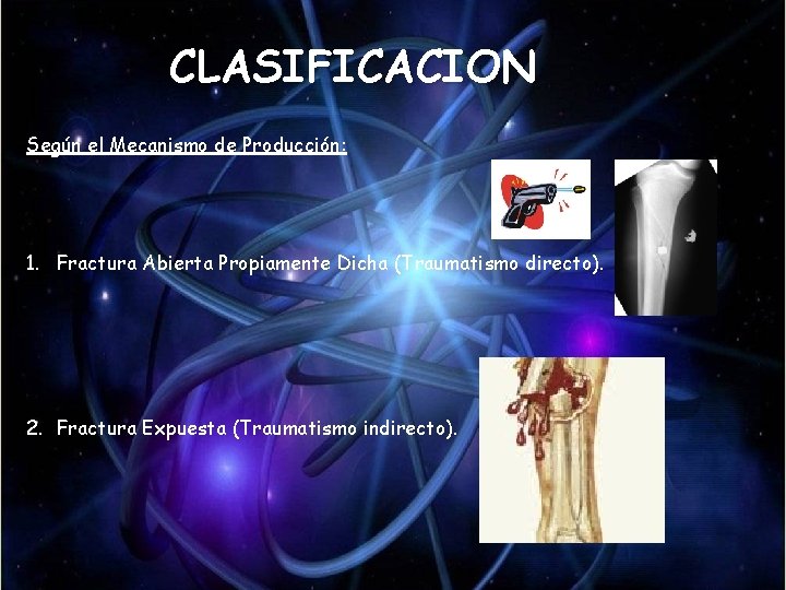 CLASIFICACION Según el Mecanismo de Producción: 1. Fractura Abierta Propiamente Dicha (Traumatismo directo). 2. CLASIFICACION Según el Mecanismo de Producción: 1. Fractura Abierta Propiamente Dicha (Traumatismo directo). 2.