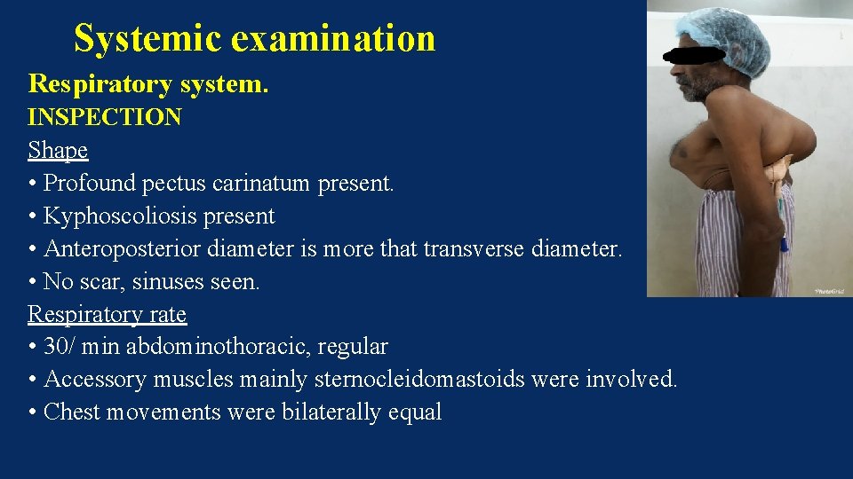 Systemic examination Respiratory system. INSPECTION Shape • Profound pectus carinatum present. • Kyphoscoliosis present