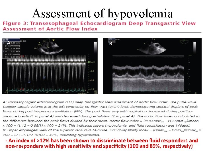 Assessment of hypovolemia - An index of >12% has been shown to discriminate between
