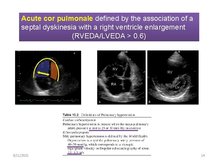 Acute cor pulmonale defined by the association of a septal dyskinesia with a right