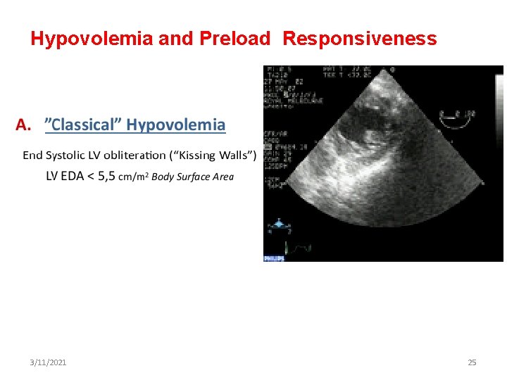 Hypovolemia and Preload Responsiveness 3/11/2021 25 