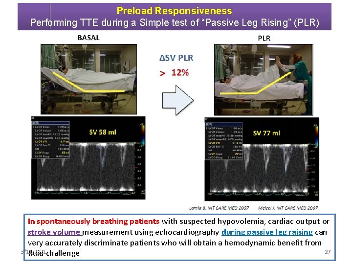 Preload Responsiveness Performing TTE during a Simple test of “Passive Leg Rising” (PLR) In