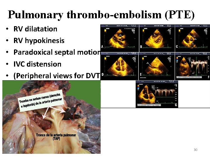 Pulmonary thrombo-embolism (PTE) • • • RV dilatation RV hypokinesis Paradoxical septal motion IVC