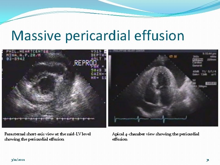 Massive pericardial effusion Parasternal short-axis view at the mid-LV level showing the pericardial effusion