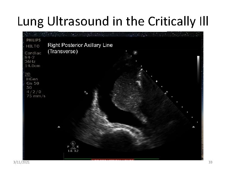 Lung Ultrasound in the Critically Ill 3/11/2021 33 