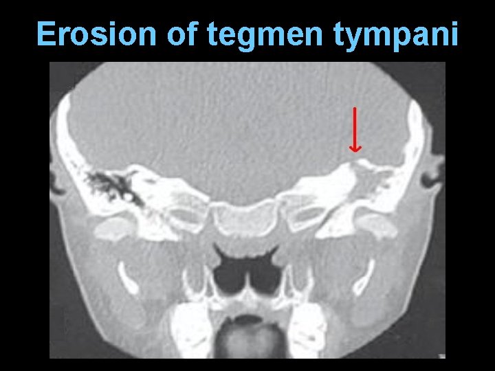 Erosion of tegmen tympani 
