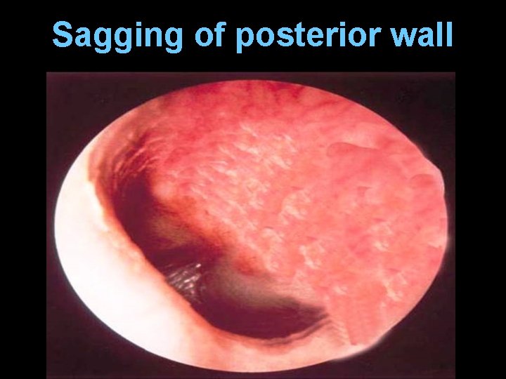 Sagging of posterior wall 