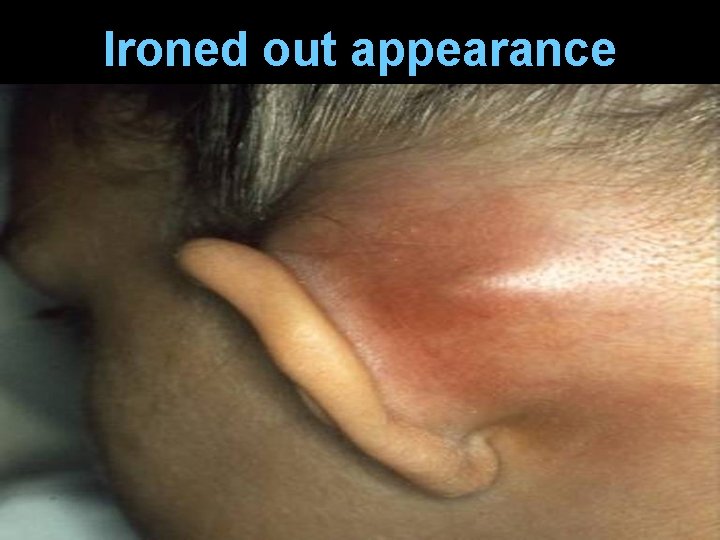 Ironed out appearance 