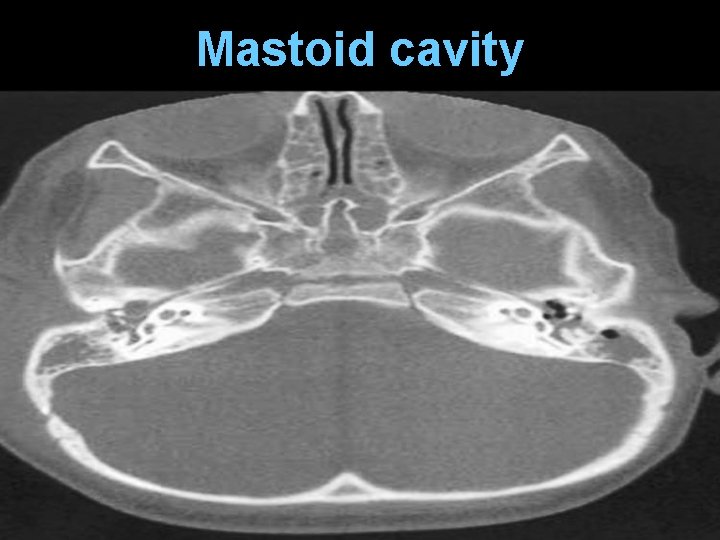 Mastoid cavity 
