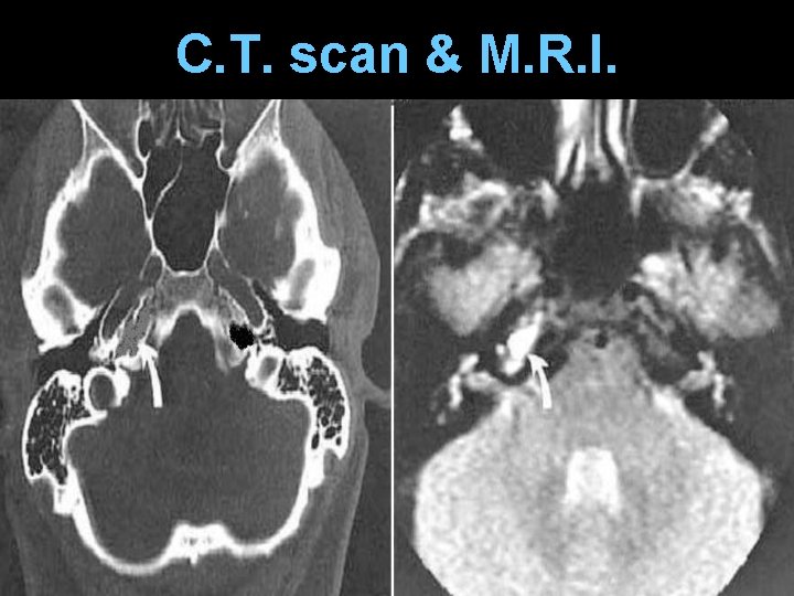 C. T. scan & M. R. I. 