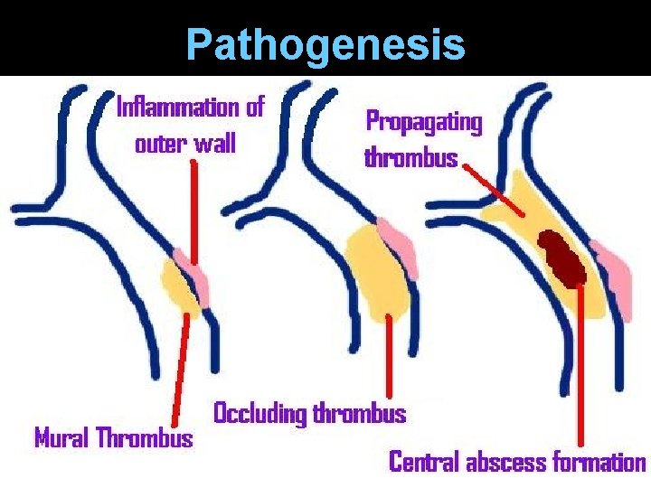 Pathogenesis 
