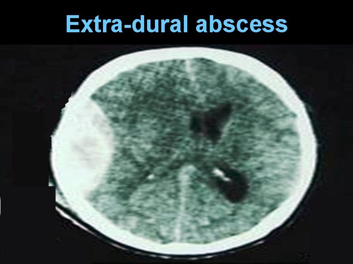 Extra-dural abscess 