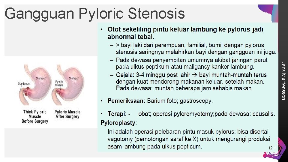 Gangguan Pyloric Stenosis Jens Martensson 15 