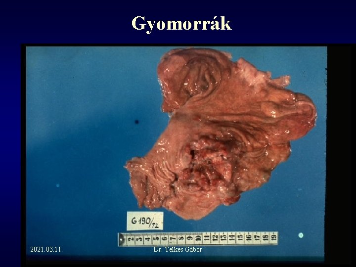 gyomorrák vagotomia does heat kill giardia