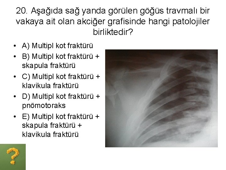 20. Aşağıda sağ yanda görülen göğüs travmalı bir vakaya ait olan akciğer grafisinde hangi