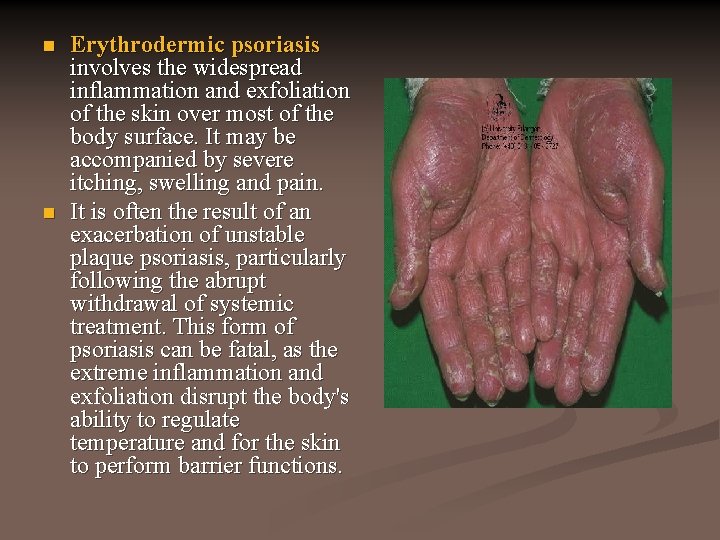 n n Erythrodermic psoriasis involves the widespread inflammation and exfoliation of the skin over