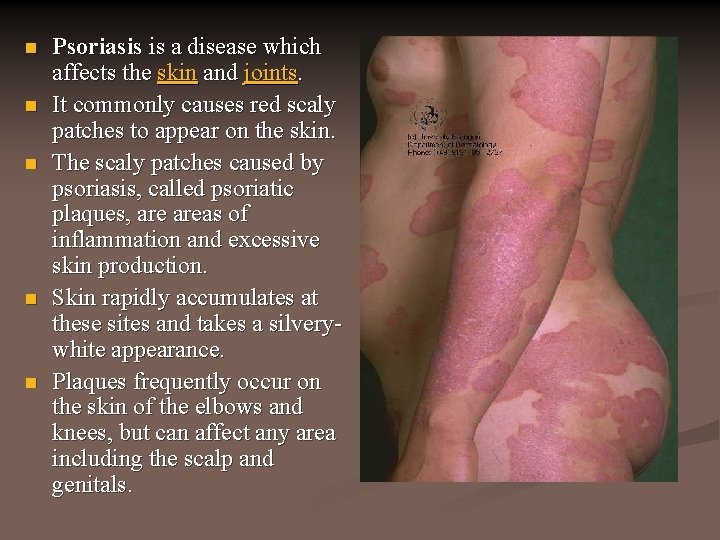 n n n Psoriasis is a disease which affects the skin and joints. It