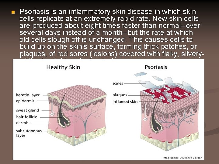 psoriasis is an inflammatory skin condition)