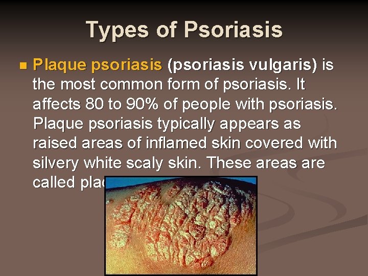 Types of Psoriasis n Plaque psoriasis (psoriasis vulgaris) is the most common form of