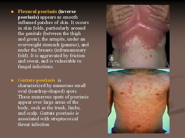 n Flexural psoriasis (inverse psoriasis) appears as smooth inflamed patches of skin. It occurs