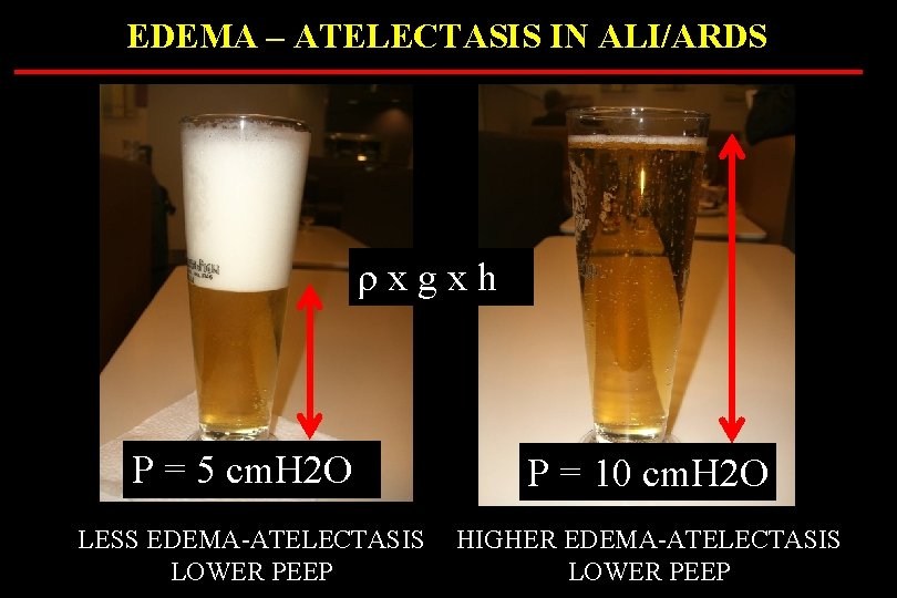 EDEMA – ATELECTASIS IN ALI/ARDS ρxgxh P = 5 cm. H 2 O LESS