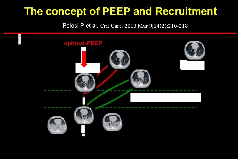 The concept of PEEP and Recruitment Pelosi P et al. Crit Care. 2010 Mar