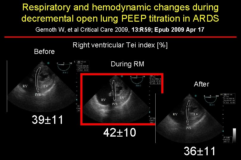 Respiratory and hemodynamic changes during decremental open lung PEEP titration in ARDS Gernoth W,