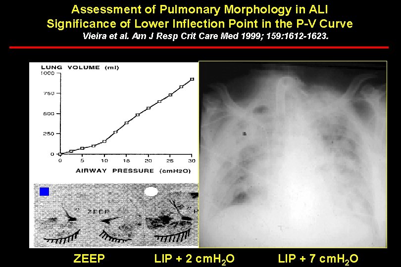 Assessment of Pulmonary Morphology in ALI Significance of Lower Inflection Point in the P-V