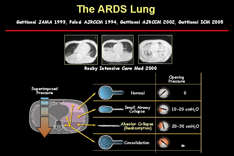 The ARDS Lung Gattinoni JAMA 1993, Pelosi AJRCCM 1994, Gattinoni AJRCCM 2002, Gattinoni ICM