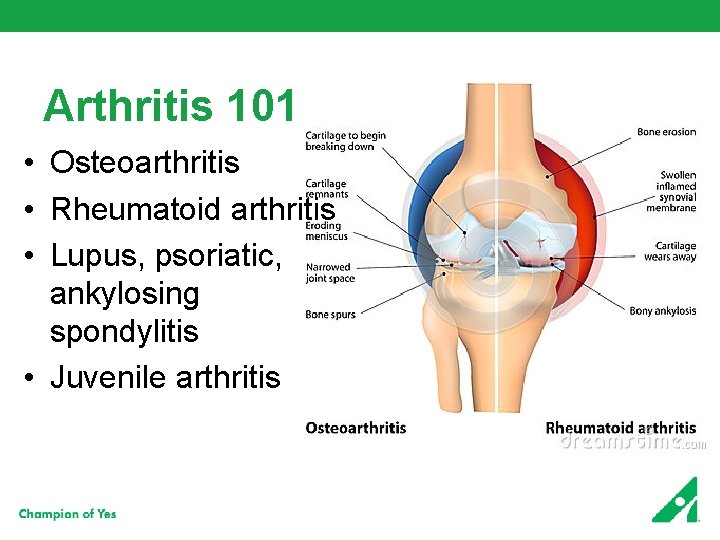 Arthritis 101 • Osteoarthritis • Rheumatoid arthritis • Lupus, psoriatic, ankylosing spondylitis • Juvenile