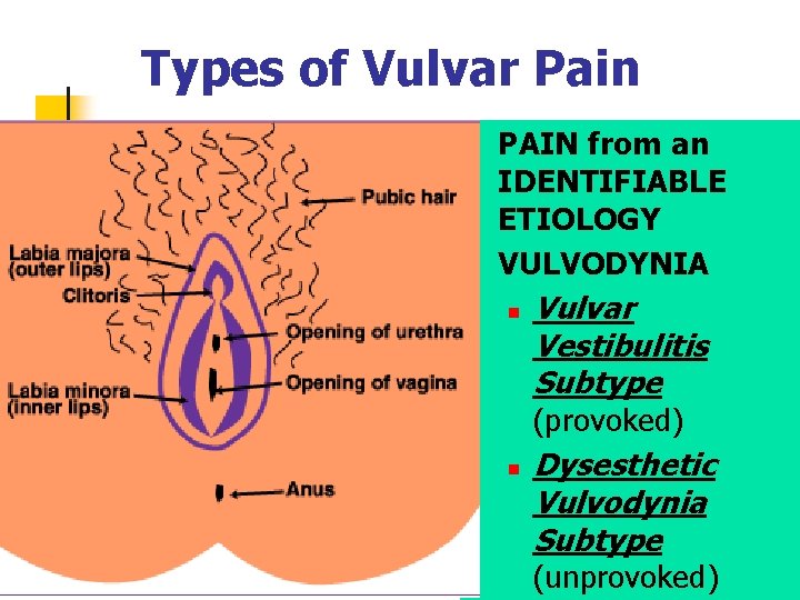 Types of Vulvar Pain n n PAIN from an IDENTIFIABLE ETIOLOGY VULVODYNIA n Vulvar
