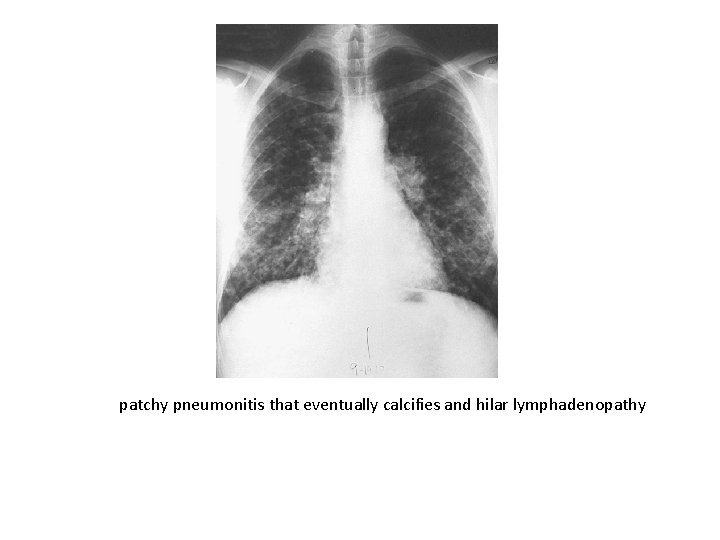  patchy pneumonitis that eventually calcifies and hilar lymphadenopathy 
