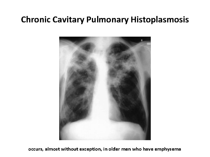 Chronic Cavitary Pulmonary Histoplasmosis occurs, almost without exception, in older men who have emphysema