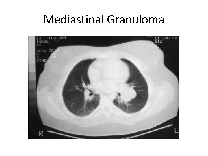 Mediastinal Granuloma 