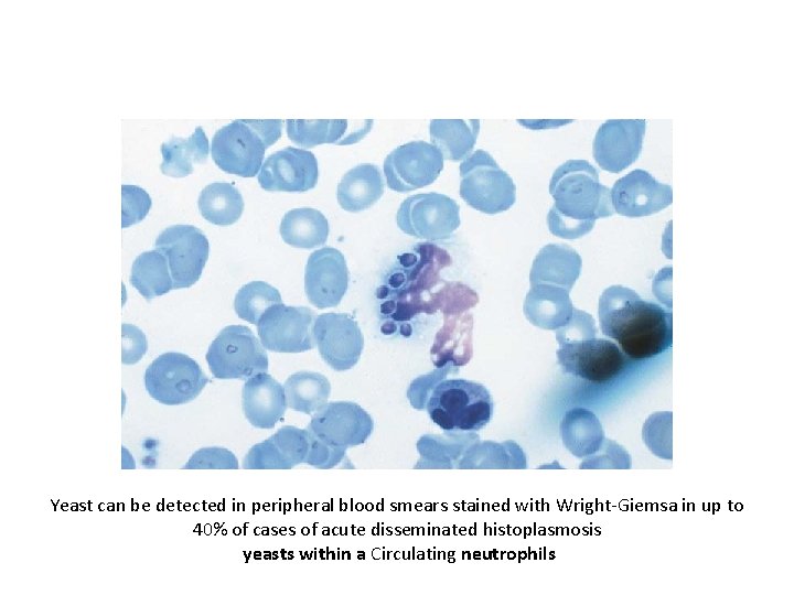 Yeast can be detected in peripheral blood smears stained with Wright-Giemsa in up to