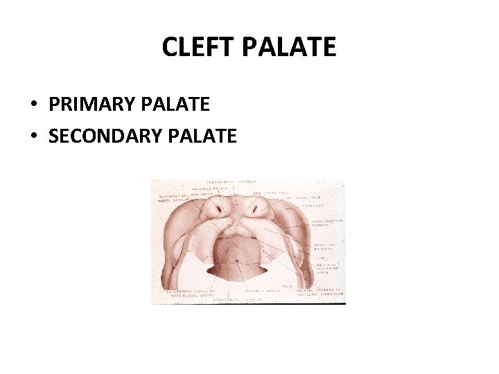 CLEFT PALATE • PRIMARY PALATE • SECONDARY PALATE 