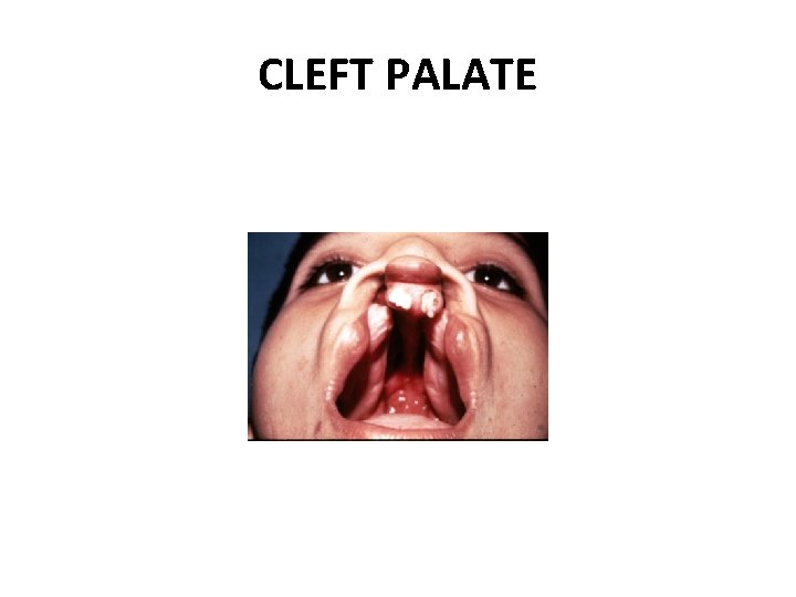 CLEFT PALATE 