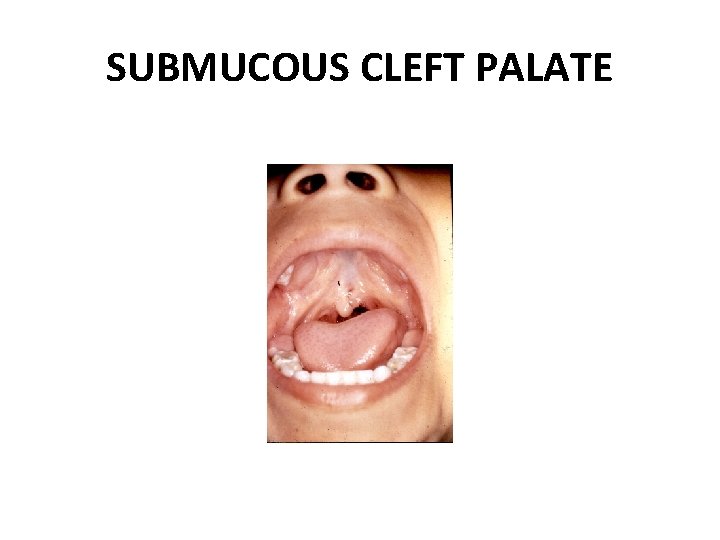 SUBMUCOUS CLEFT PALATE 