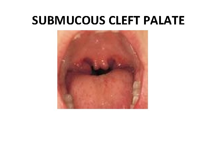 SUBMUCOUS CLEFT PALATE 