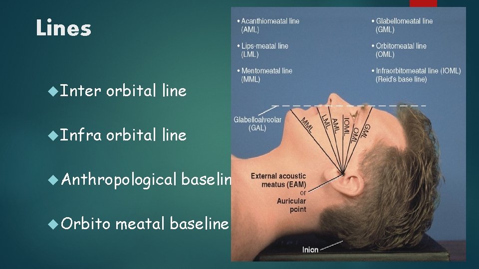 Lines Inter orbital line Infra orbital line Anthropological Orbito baseline meatal baseline 