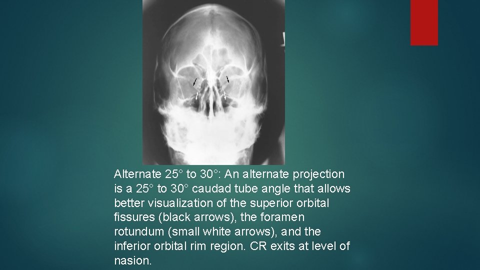 Alternate 25° to 30°: An alternate projection is a 25° to 30° caudad tube