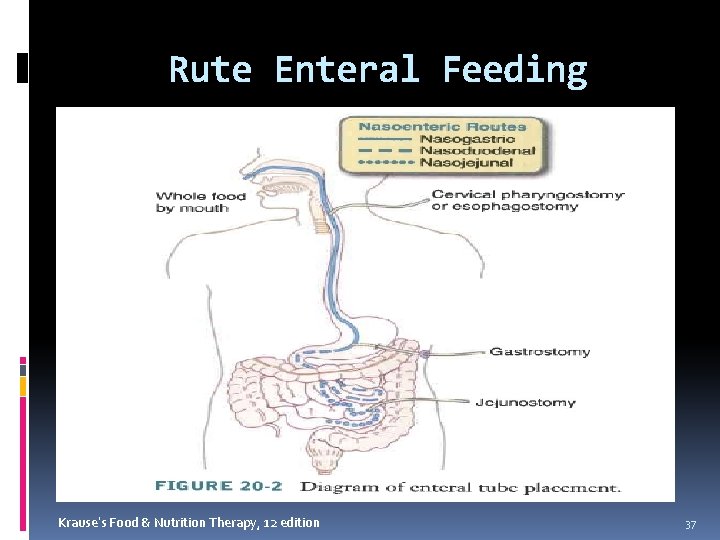 Rute Enteral Feeding Krause’s Food & Nutrition Therapy, 12 edition 37 