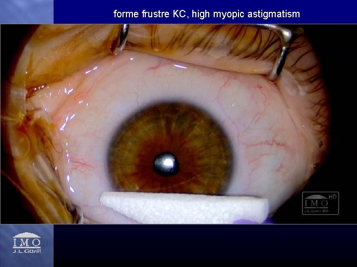 forme frustre KC, high myopic astigmatism 