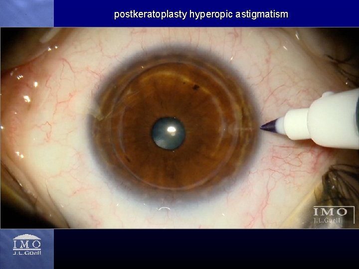 postkeratoplasty hyperopic astigmatism 